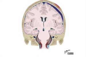 Hirnblutung/chronisches Subduralhämatom - die Neurochirurgie ist präpotent und die Neurologie naiv. Teil 3