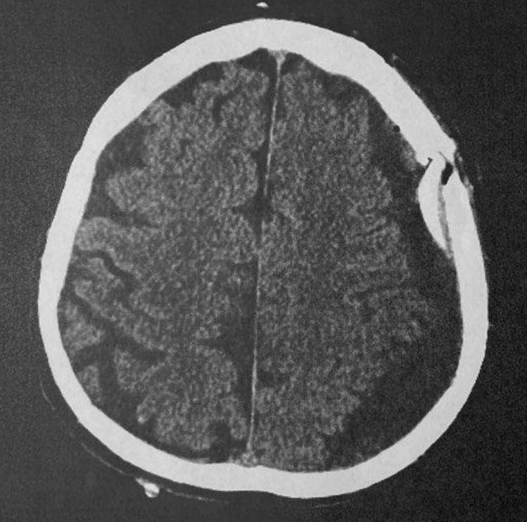 Hirnblutung/chronisches Subduralhämatom - die Neurochirurgen sind leider nicht nur präpotent und die Neurologen wider besseren Wissenmüssens naiv. Teil 4